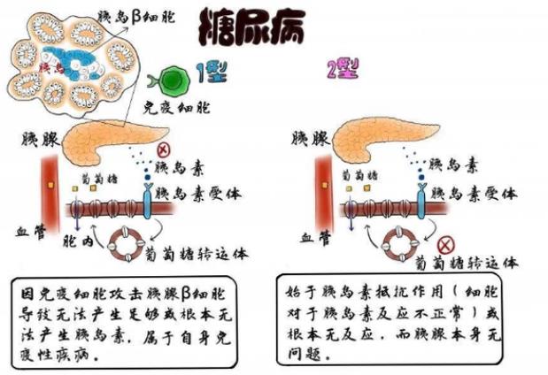 高血糖有哪些并發(fā)癥 愛(ài)吃辣的人會(huì)得糖尿病嗎