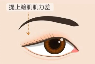 合肥愛爾專家科普：上瞼下垂＝眼皮松弛？其實(shí)真相是……