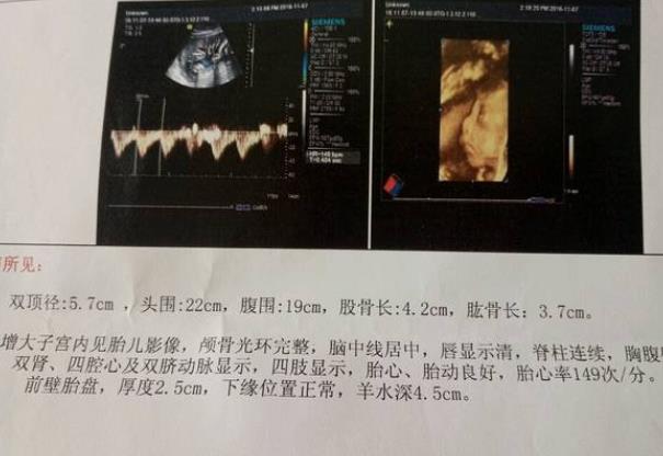 四維彩超篩查范圍廣嗎 五個(gè)半月可以做四維嗎