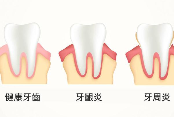 牙周炎能吃海鮮嗎？牙周炎如何自我判斷？