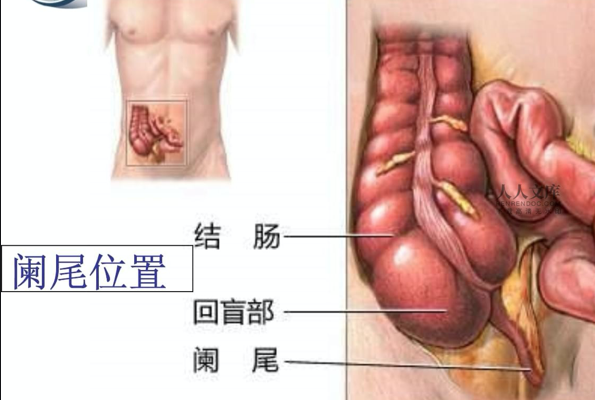 慢性闌尾炎有危險嗎 慢性闌尾炎不治療會怎樣