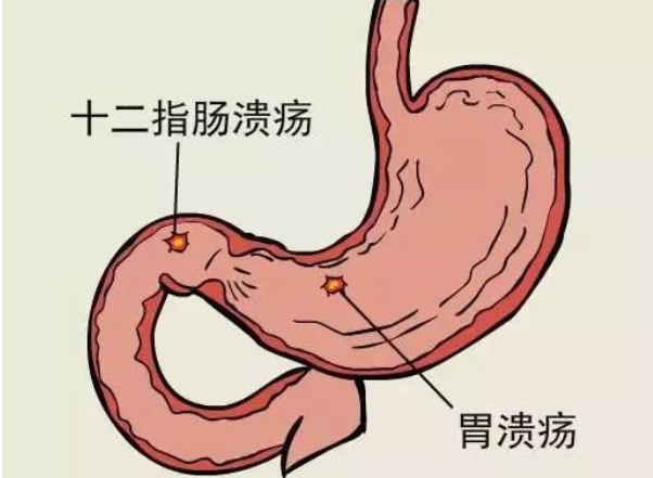 胃潰瘍會造成幽門梗阻嗎 胃潰瘍嚴(yán)重了會怎樣