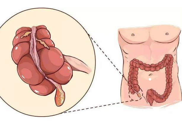 急性闌尾炎腹痛有哪些特點(diǎn) 闌尾炎除了痛還有什么表現(xiàn)