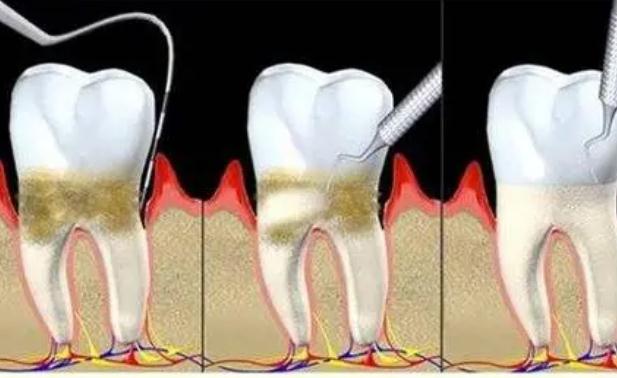 牙周炎跟腎虛有關(guān)系嗎？牙周炎跟上火有關(guān)系嗎？
