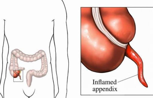 闌尾炎會(huì)死人嗎 闌尾炎會(huì)吐嗎