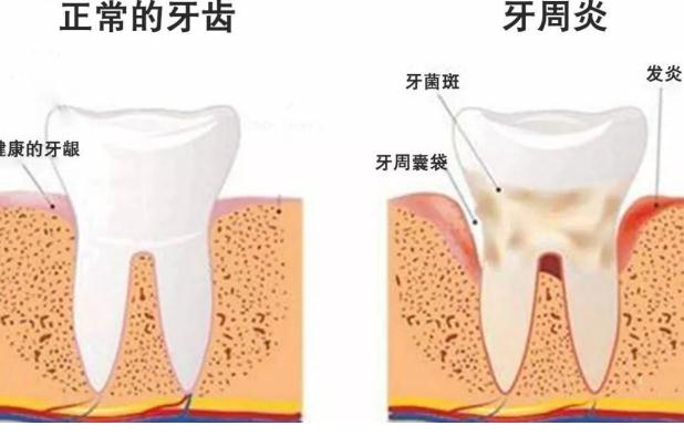 牙周炎檢查？牙周炎小偏方？