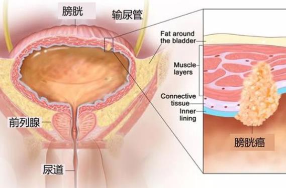 膀胱癌晚期會怎么樣 膀胱癌早期是什么癥狀