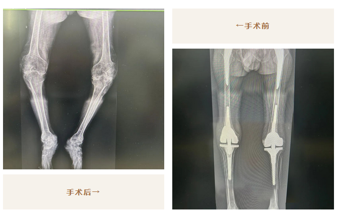 太厲害了！我院骨科助力26年不能站立的他，重新行走！