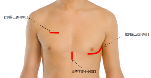 重大突破！福建首創(chuàng)長(zhǎng)期人工心臟微創(chuàng)植入術(shù)