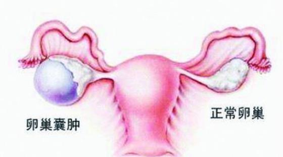 卵巢囊腫可以進行房事嗎 得卵巢囊腫孩子還能要嗎