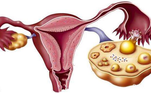 肥胖會導(dǎo)致多囊卵巢綜合征嗎 多囊卵巢綜合征有哪些危害