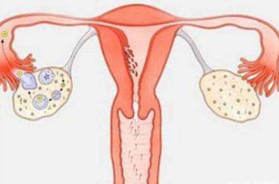 多囊卵巢綜合征怎么治療 多囊卵巢綜合征多久能治好