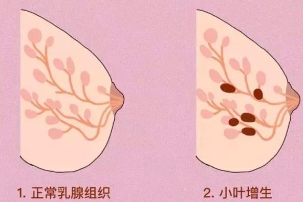 內(nèi)分泌絮亂會(huì)導(dǎo)致乳腺增生嗎 乳腺增生腋窩里會(huì)疼嗎