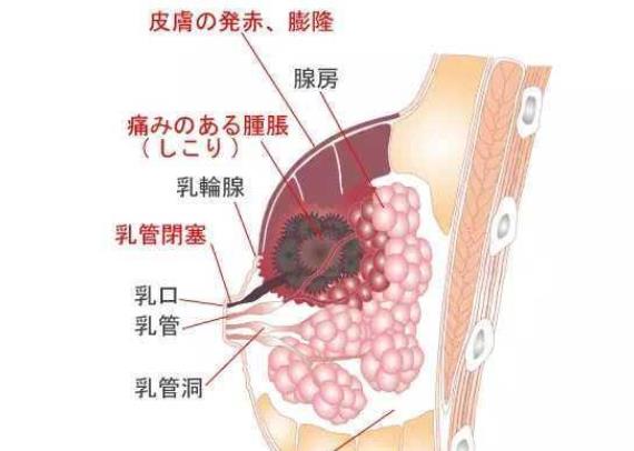 乳腺炎患者能運(yùn)動(dòng)嗎 如何才能根治乳腺炎