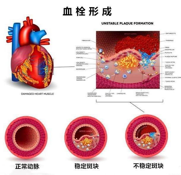 腦梗、頭暈、眼黑總是反復(fù)？血脈通栓化斑方就能調(diào)理！