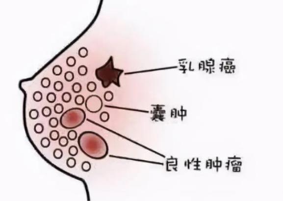 乳腺結(jié)節(jié)能懷孕嗎 乳腺結(jié)節(jié)變大怎么回事