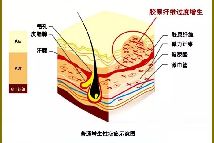 【沈陽(yáng)膚康疤痕科普】之紋身疤痕，紋身雖美，疤痕防治不可忽視