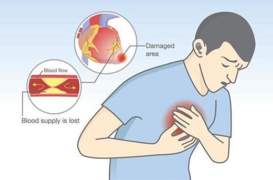心梗能治好嗎 心梗早期會(huì)怎么樣