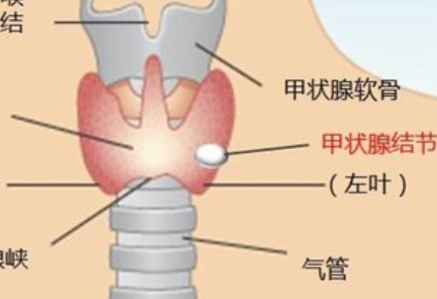 身體多處結(jié)節(jié)是不是容易得癌癥 結(jié)節(jié)癌變的幾率多大