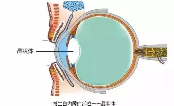 白內(nèi)障術(shù)后多久恢復(fù) 白內(nèi)障手術(shù)后多久可以運動