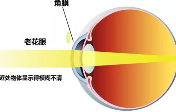 白內(nèi)障只能做超聲乳化手術(shù)嗎 白內(nèi)障超聲乳化手術(shù)多久恢復