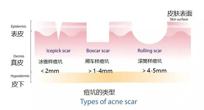 【膚康秒懂百科】光電治療萎縮性痤瘡瘢痕或成最佳選擇