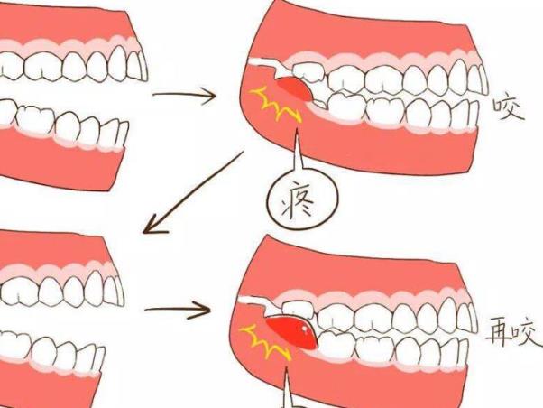 拔完智齒會(huì)疼嗎 拔智齒多久能恢復(fù)