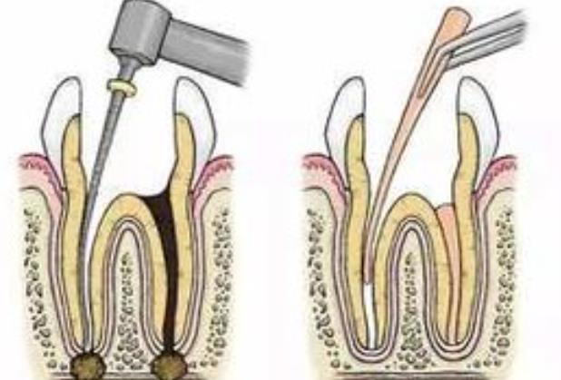 牙髓炎保髓治療復(fù)發(fā)怎么辦 牙髓炎保髓成功率是多少