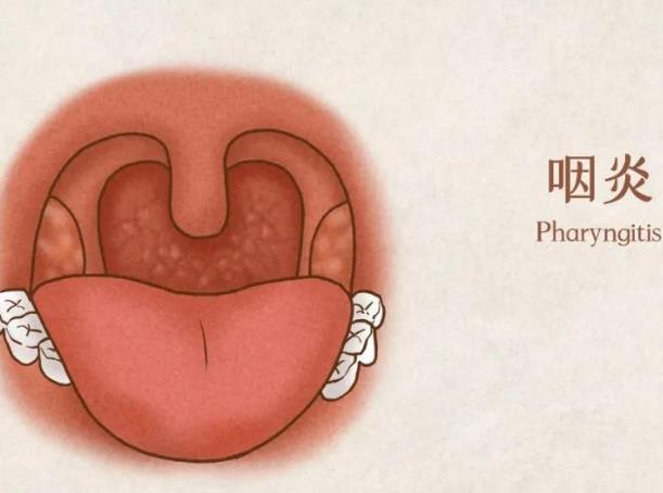 慢性咽炎吃咽炎片有效嗎 咽炎片可以長(zhǎng)期吃嗎