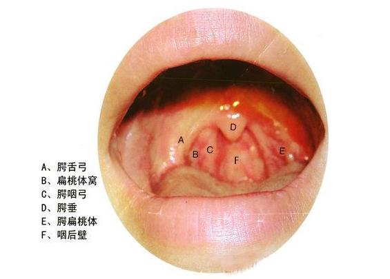 小飛蓬能治好咽炎嗎 鐵笛片對(duì)慢性咽炎有效嗎