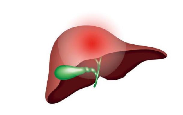 肝癌肝硬化腹水怎么辦 肝硬化腹水是不是肝癌