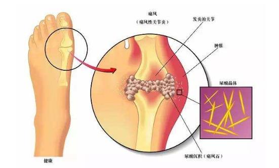 甲亢會(huì)引起尿酸高嗎 痛風(fēng)病人可用白蛋白嗎