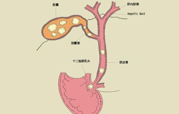 膽結(jié)石10mm怎么辦 膽結(jié)石10mm要開刀嗎