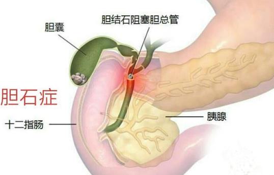 做膽結石手術多久能恢復 膽結石宜吃什么