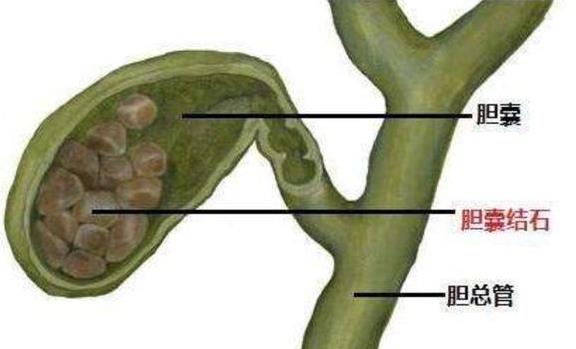 膽結石微創(chuàng)要疼多久 膽結石微創(chuàng)手術要多久