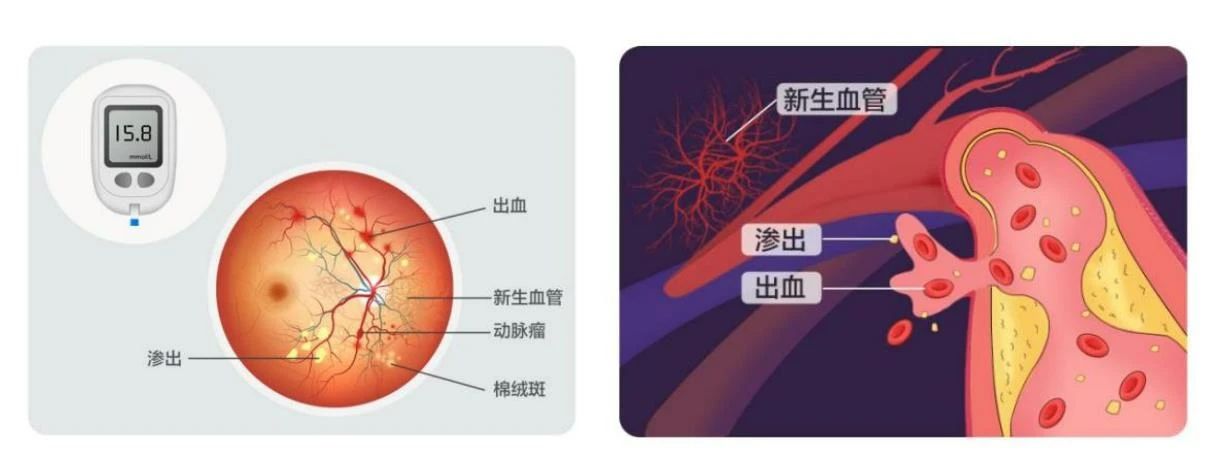 【合肥愛爾】得了糖尿病，為什么醫(yī)生讓我看眼科？