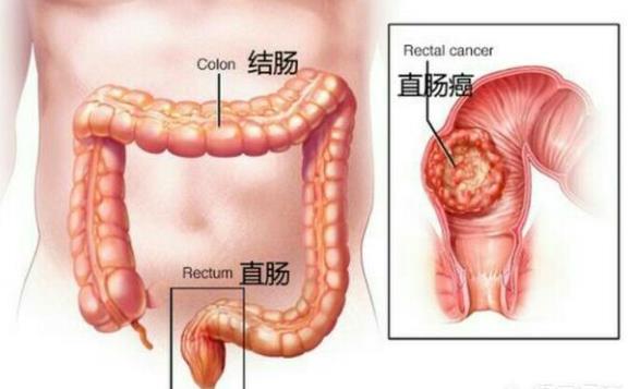 直腸癌有哪些分期 直腸癌手術分期有哪些
