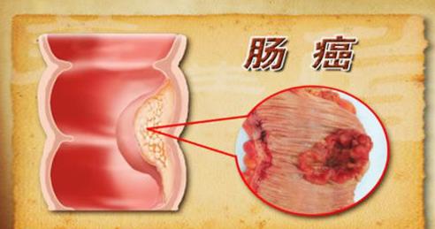 早期直腸癌有哪些癥狀 直腸癌中晚期有哪些癥狀