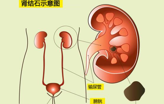 中藥能治腎結石嗎 金錢草顆粒能治腎結石嗎