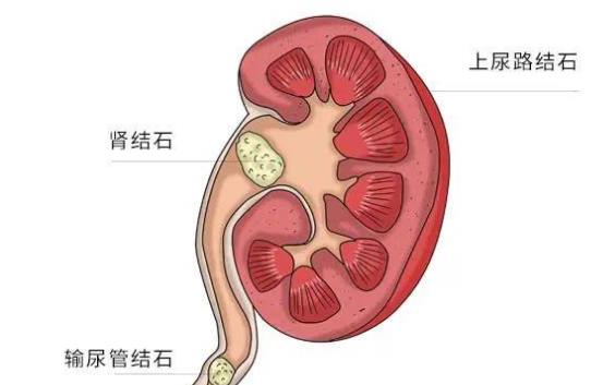 腎結石在腎里能打嗎 腎結石在腎里如何排出