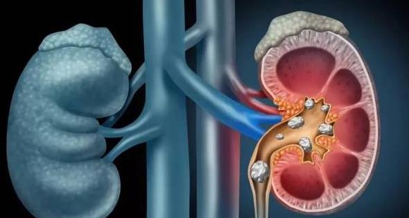 腎結石對身體有危害嗎 腎結石在輸尿管會回到腎里嗎
