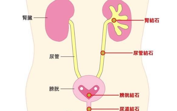 著涼會引起腎結石嗎 腎結石怕著涼嗎