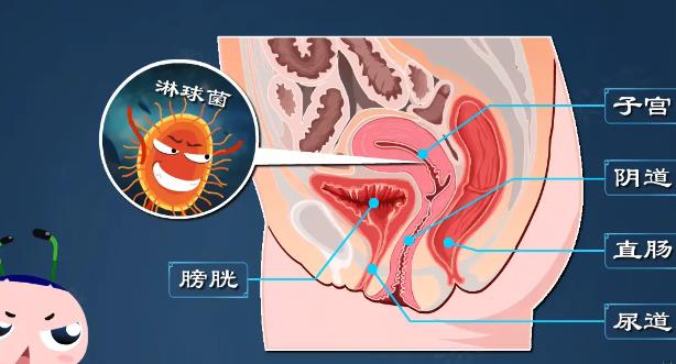 淋病治愈后還會復發(fā)嗎 淋病治好后還會傳染嗎