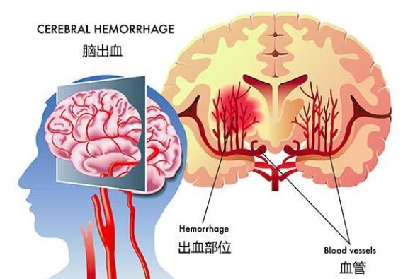 腦出血怎么急救 血壓多少會腦出血