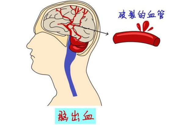 腦出血是什么原因?qū)е?不良生活習(xí)慣高血壓顱腦外傷