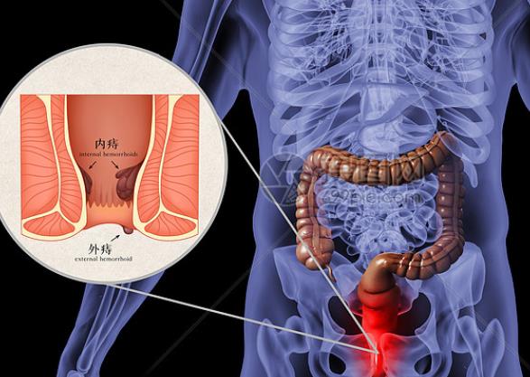 痔瘡會導(dǎo)致便秘嗎 痔瘡不痛不癢怎么回事