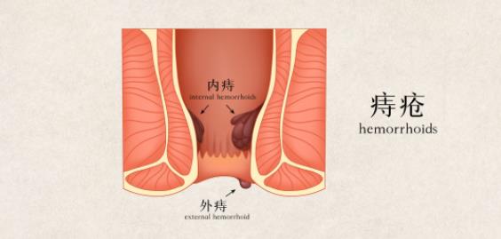 痔瘡長期出血會癌變嗎 長期痔瘡出血會怎么樣