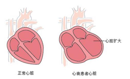 感冒會(huì)誘發(fā)心衰嗎 冠心病會(huì)誘發(fā)心衰嗎