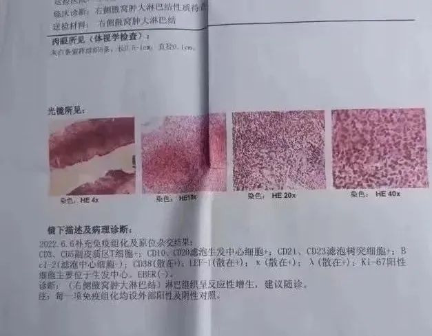 發(fā)熱原因不明，PET-CT診斷罕見成人斯蒂爾病